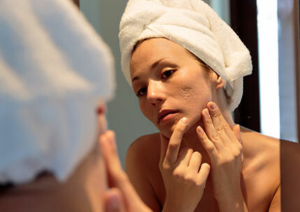 Acne Scar Treatment