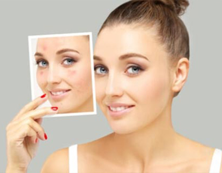 Benefits Of Acne Scar Treatment