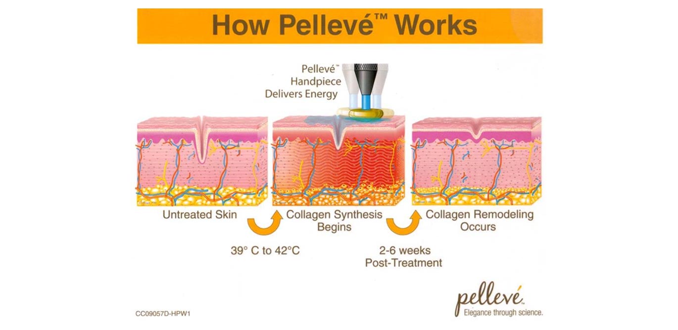 Pelleve Cosmetic