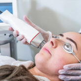 Rf Microneedling