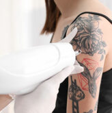 Tatto Removal