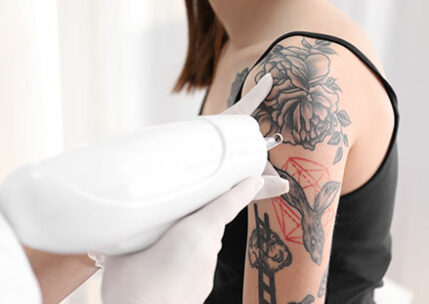 Tatto Removal