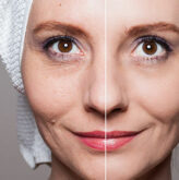 Ultherapy Skin Tightening