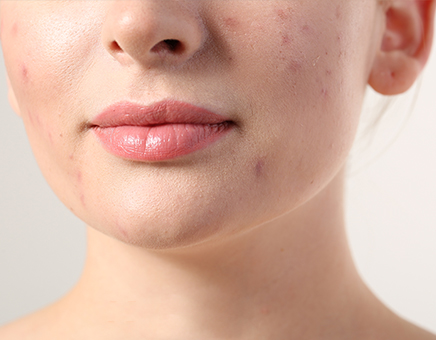 Which Skin Lesions Are Suitable For Pelleve