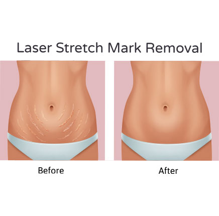 Stretch Mark Removal 1