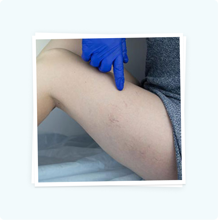 Fast, Easy, And Comfortable Vessel Treatments Fast, Easy, And Comfortable Vessel Treatments