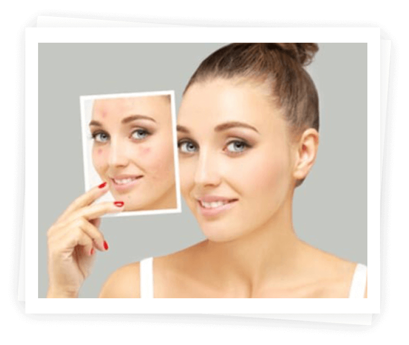 Benefits Of Acne Scar Benefits Of Acne Scar