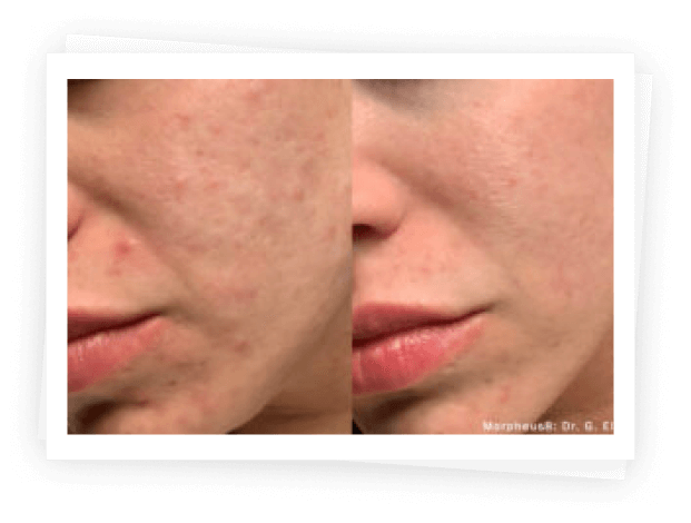 Morpheus8 Treatment Morpheus8 Treatment
