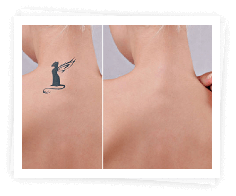 What is PicoSure? What is PicoSure?