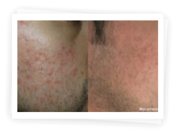 Morpheus8 Treatment Morpheus8 Treatment