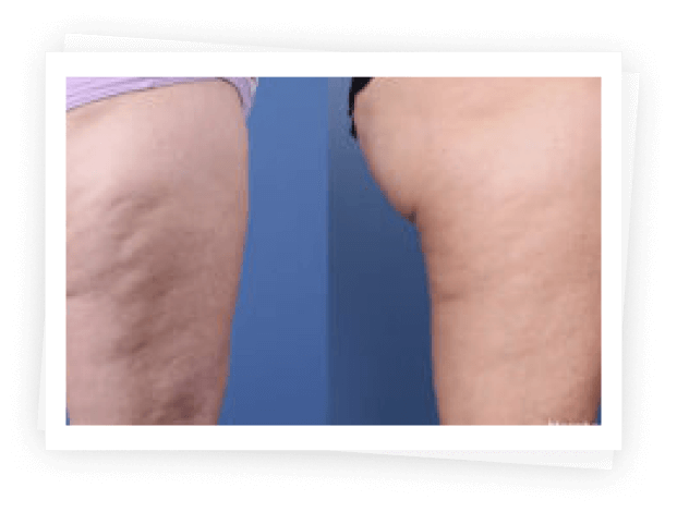 Morpheus8 Treatment Morpheus8 Treatment