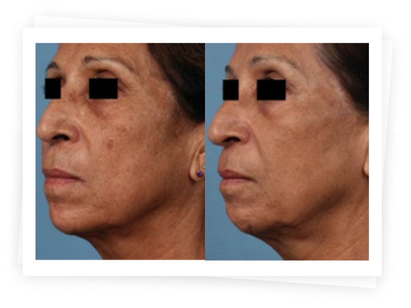 How Does The Picosure Laser Remove Unwanted Pigments In The Skin How Does The Picosure Laser Remove Unwanted Pigments In The Skin