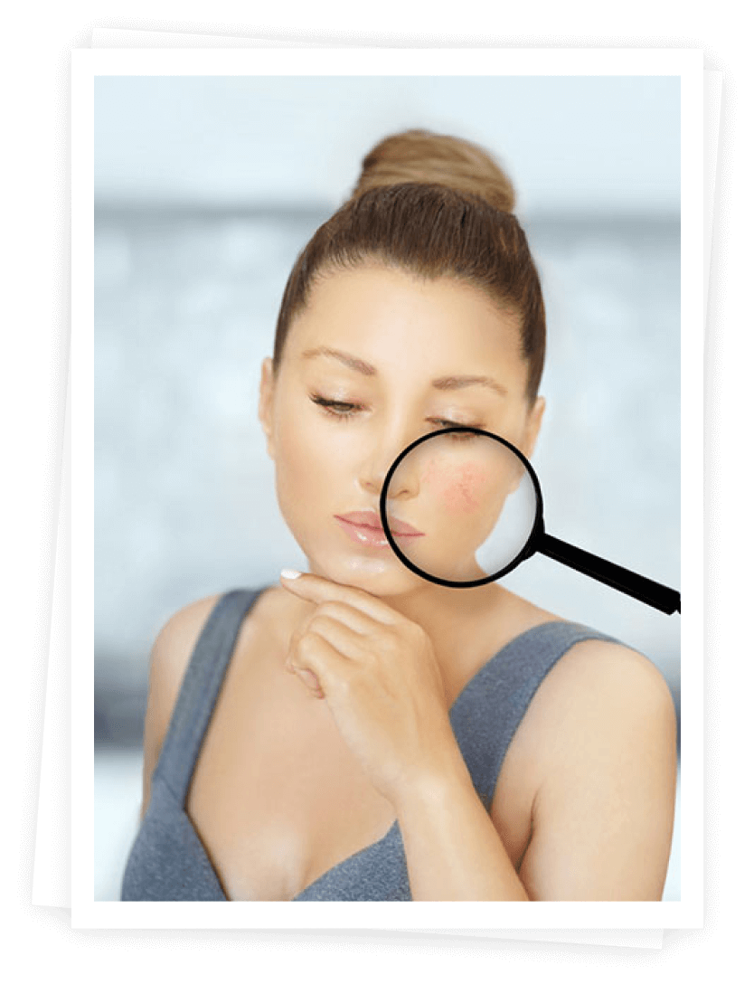 Light-based Rosacea Treatment Light-based Rosacea Treatment