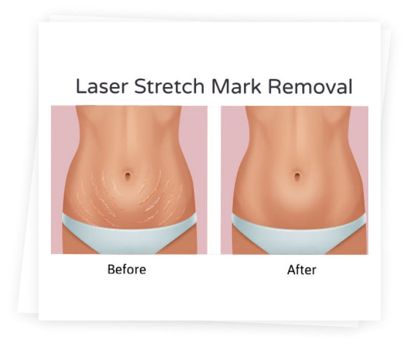 Stretch Mark Removal With Melbourne Clinical Laser Stretch Mark Removal With Melbourne Clinical Laser