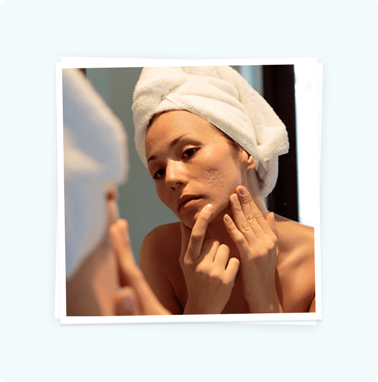 Picosure For Acne Scar Treatment Picosure For Acne Scar Treatment