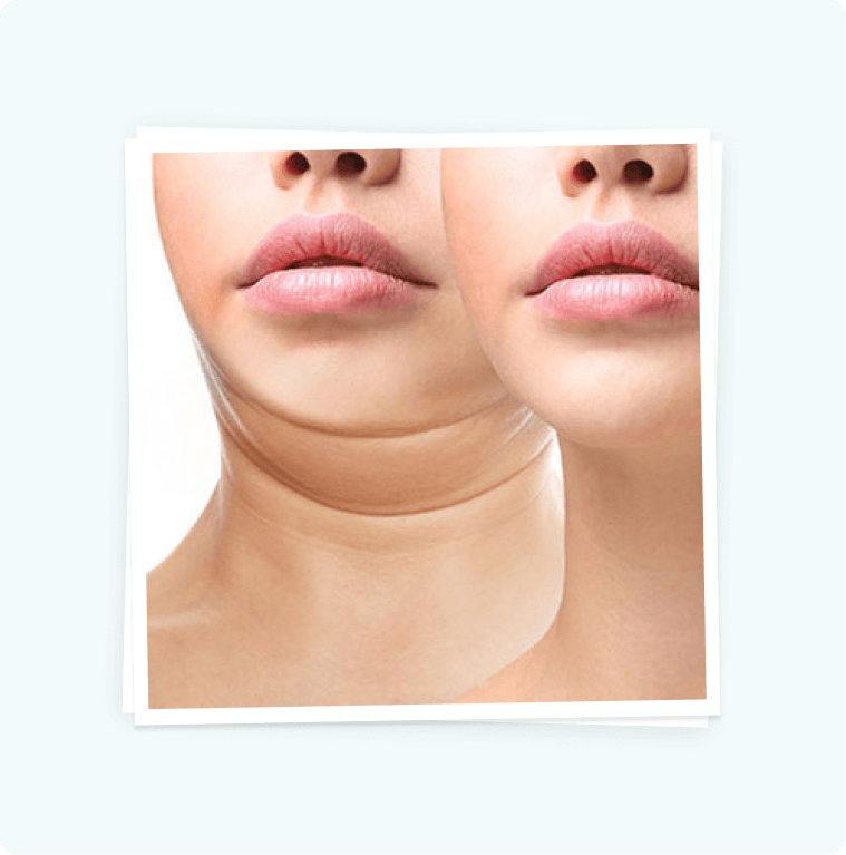 Double Chin Injections Double Chin Injections