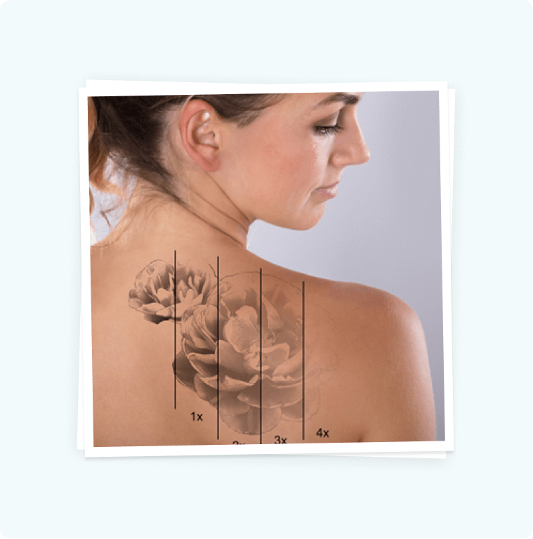 Tattoo Removal Tattoo Removal