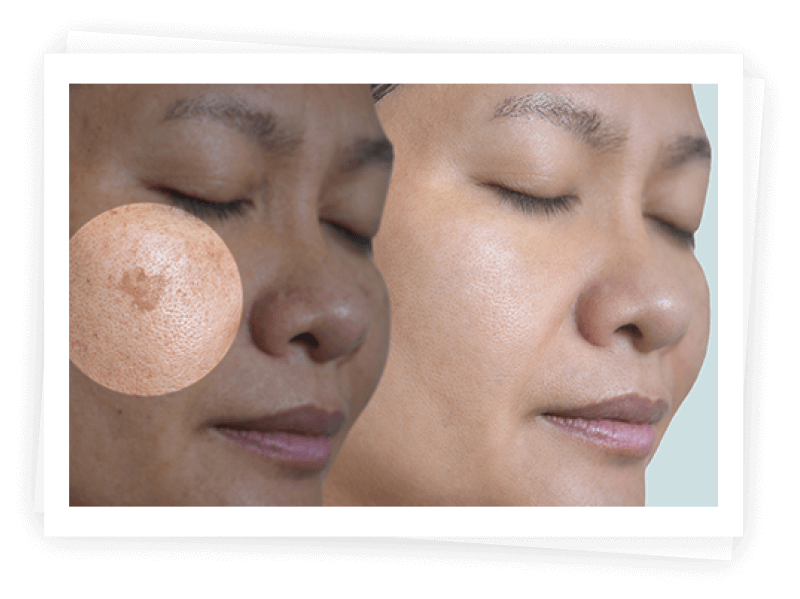 Picosure Treatment Picosure Treatment
