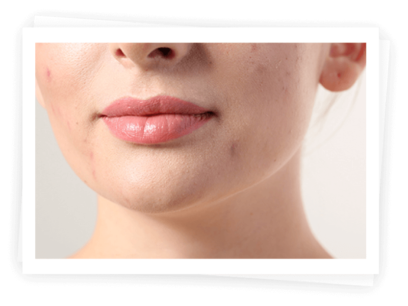 Which Skin Lesions Are Suitable For Pelleve? Which Skin Lesions Are Suitable For Pelleve?